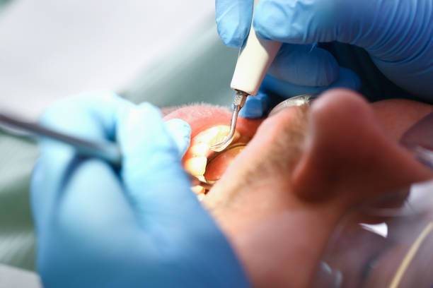 Best Emergency Wisdom Tooth Extraction in Lexington, MO